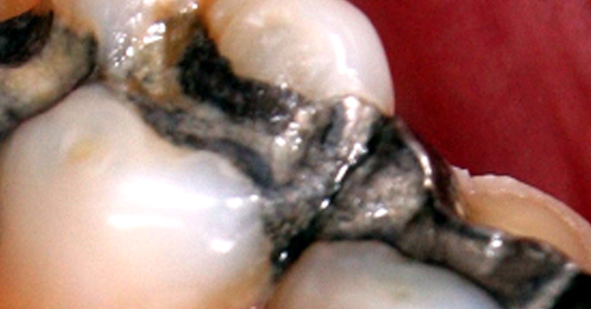 Die Füllung im Zahn lassen! – Experte rät von vorsorglicher Amalgam-Entfernung ab